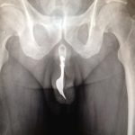 Insolite : Un homme de 70 ans est opéré après s’être inséré une fourchette dans le pénis