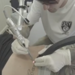 Voyez le processus pour faire enlever un tatouage