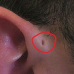 Voici pourquoi certaines personnes ont de petits trous sur les oreilles